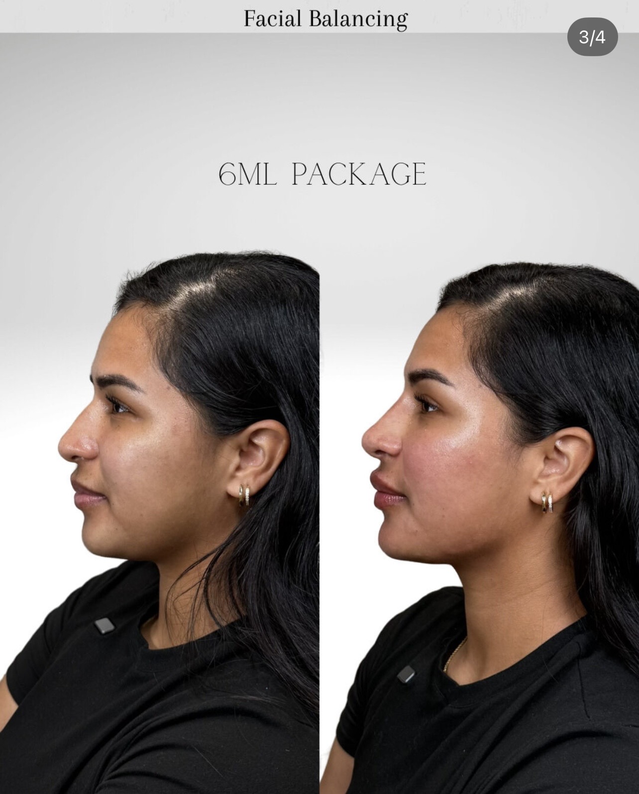 Facial Balancing before and after
